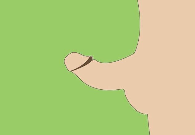 zakilaren kurbadura handitze kirurgikorako zantzu gisa